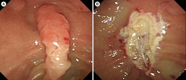 Screening and surveillance for hereditary colorectal cancer.