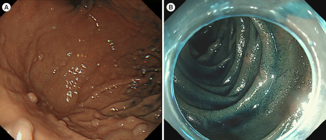 Screening and surveillance for hereditary colorectal cancer.