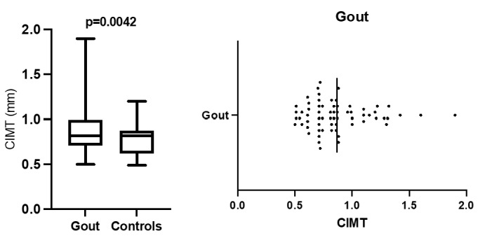 Subclinical Atherosclerosis in a Gout Cohort: Prevalence and Associations.