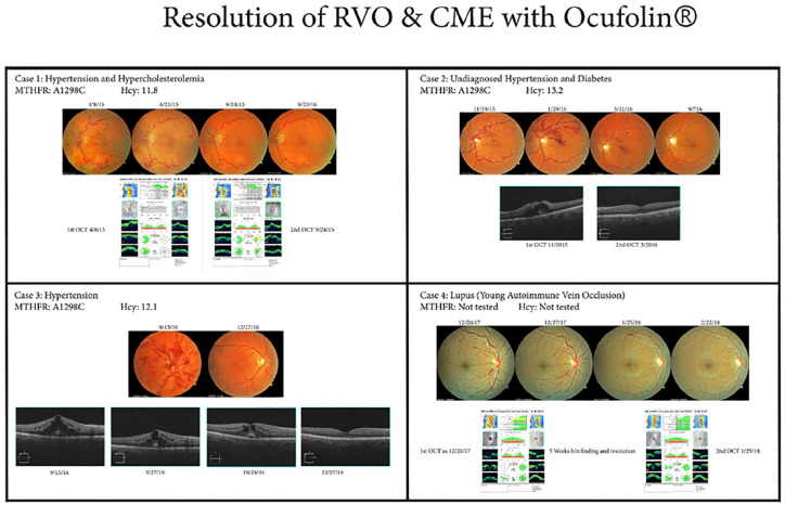 Case series of retinal vein occlusions showing early recovery using oral l-methylfolate.