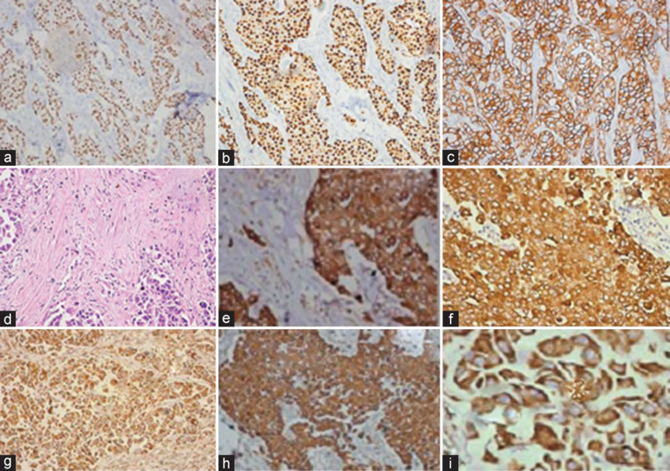 Vascular Endothelial Growth Factor Expression by Immunohistochemistry as a Possible Indicator of Prognosis in Invasive Breast Carcinoma of No Special Type.