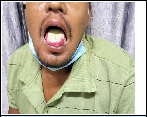 Paraquat Toxicity Leading to Acute Kidney Injury: A Case Report in an Adult Patient.