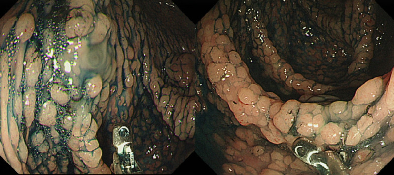 Screening and surveillance for hereditary colorectal cancer.