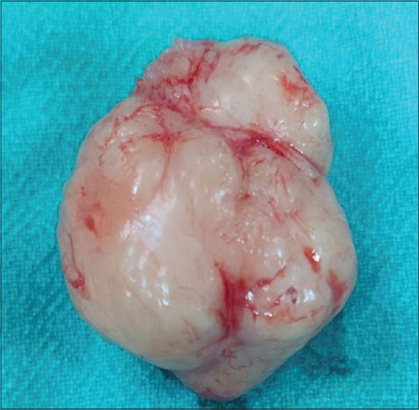 Primary Vaginal Leiomyosarcoma Mimicking Bartholin's Cyst.