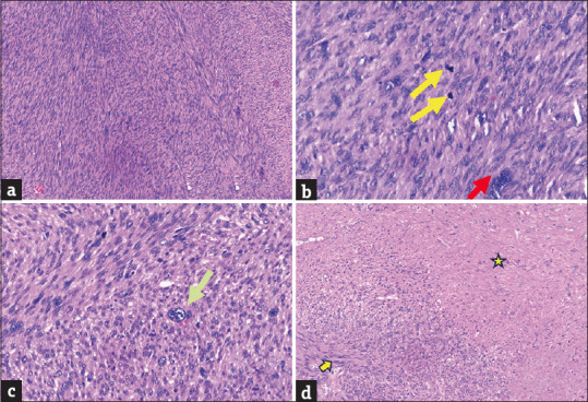 Primary Vaginal Leiomyosarcoma Mimicking Bartholin's Cyst.