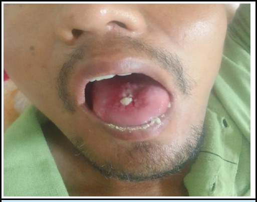 Paraquat Toxicity Leading to Acute Kidney Injury: A Case Report in an Adult Patient.