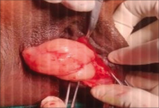 Primary Vaginal Leiomyosarcoma Mimicking Bartholin's Cyst.