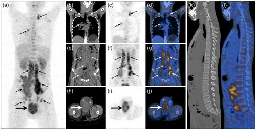 18F-FDG PET/CT findings of paratesticular alveolar rhabdomyosarcoma