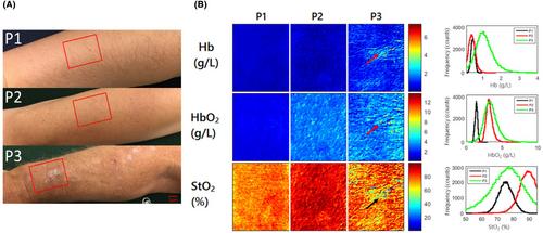 Mapping cutaneous field carcinogenesis of nonmelanoma skin cancer using mesoscopic imaging of pro-inflammation cues