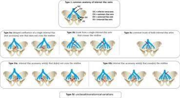 An updated classification of the anatomical variations of the internal iliac venous drainage system: Surgical implications for anterior lumbar spinal approaches