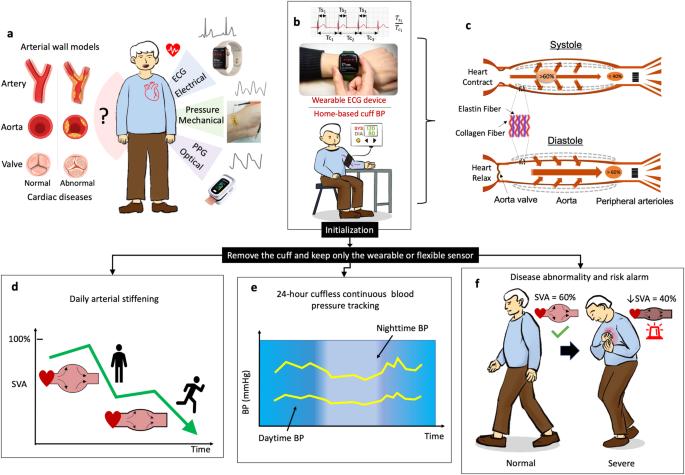 Stroke-volume-allocation model enabling wearable sensors for vascular age and cardiovascular disease assessment