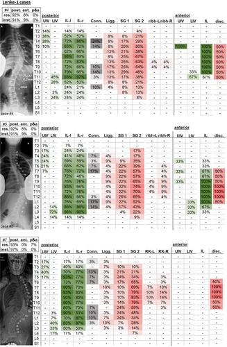 Range of international surgical strategies for adolescent idiopathic scoliosis: Evaluation of a multi-center survey