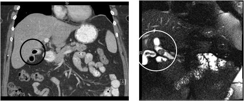 Robotic management of primary cholecystoduodenal fistula: A case report and brief literature review