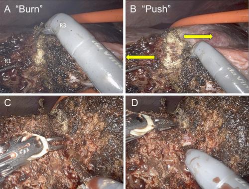 ‘Burn and Push’ technique: A novel robotic liver parenchymal transection technique