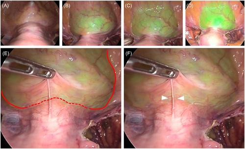 Intraoperative bladder visualization by indocyanine green filling and subsequent washout in endoscopic hysterectomy: ICG-Washout method