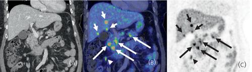 Prevalence of metastases outside the liver and abdominal lymph nodes on 68Ga-DOTATOC-PET/CT in patients with small intestinal and pancreatic neuroendocrine tumours