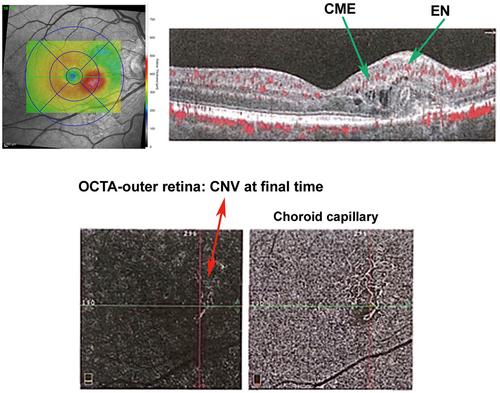 Psychophysical, electrofunctional, and morphological evaluation in naïve neovascular AMD patients treated with intravitreal anti-VEGF