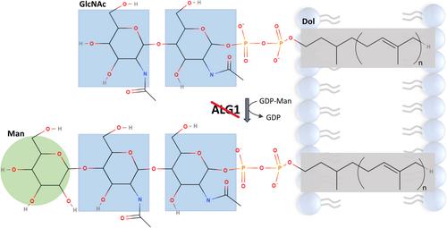 Normal transferrin glycosylation does not rule out severe ALG1 deficiency