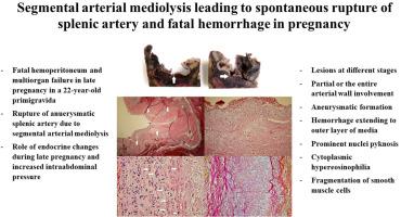 Segmental arterial mediolysis leading to spontaneous rupture of splenic artery and fatal hemorrhage in pregnancy