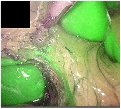 Novel navigation for laparoscopic cholecystectomy fusing artificial intelligence and indocyanine green fluorescent imaging