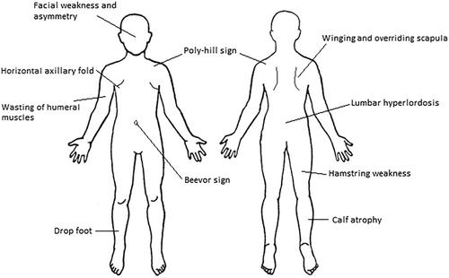 Best practice guidelines on genetic diagnostics of facioscapulohumeral muscular dystrophy: Update of the 2012 guidelines