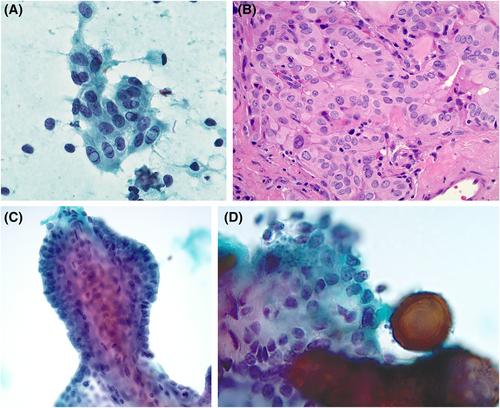 Papillae, psammoma bodies, and/or many nuclear pseudoinclusions are helpful criteria but should not be required for a definitive cytologic diagnosis of papillary thyroid carcinoma: An institutional experience of 207 cases with surgical follow up