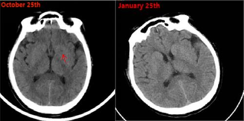 Experience of treatment in critical Guillain-Barre Syndrome case after COVID-19 vaccination