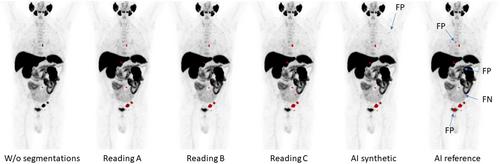 Improving sensitivity through data augmentation with synthetic lymph node metastases for AI-based analysis of PSMA PET-CT images