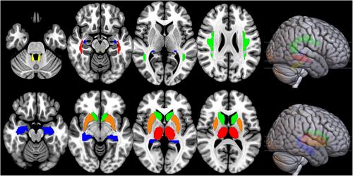 Cognitive outcome and its neural correlates after cardiorespiratory arrest in childhood