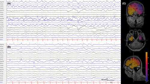 Ictal Cotard delusion as a manifestation of nonconvulsive status epilepticus: A case report and commentary