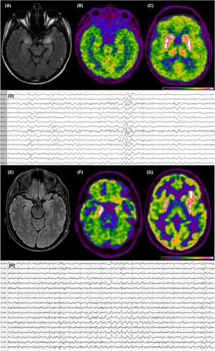 Ma2 antibody-associated limbic encephalitis: The early etiology treatment may modify the disease clinical trajectory