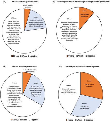 Performance of preferentially expressed antigen in melanoma (PRAME) immunohistochemistry for metastatic melanoma in cytology specimens