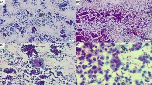 An odd dancing couple. Non-small cell lung carcinoma with coexisting EGFR mutation and NTRK-1 translocation: A case report