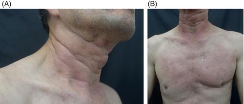 Cutaneous crystal storing histiocytosis: A case series with review of literature