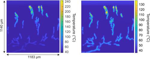 Modeling pulsed dye laser treatment of psoriatic plaques by combining numerical methods and image-derived lesion morphologies