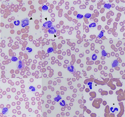 Presumed pseudo-Pelger–Huët anomaly and basophilia secondary to chronic lymphocytic leukemia in a dog