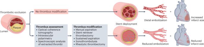 Interventional thrombus modification in STEMI