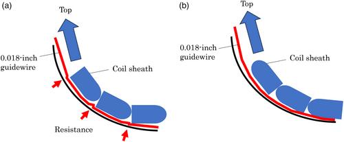 The extraction of difficult bile duct stones in a patient with surgically altered anatomy using a novel retrieval basket and a short-type single-balloon enteroscopy