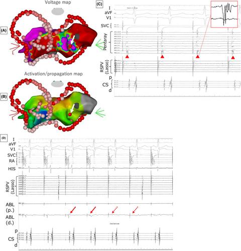 Uncoupling endocardial bundles coupled by an epicardial bundle in the left atrium and pulmonary veins