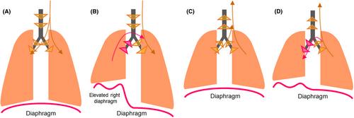 Improvement in respiratory function and exercise tolerance following video-assisted thoracoscopic diaphragm plication for symptomatic iatrogenic persistent diaphragm paralysis after radiofrequency catheter ablation