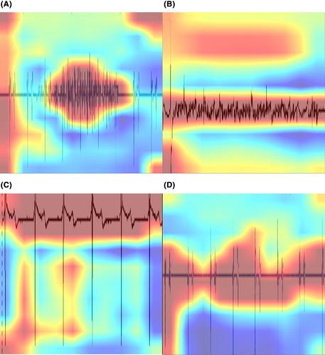 Artificial intelligence to detect noise events in remote monitoring data