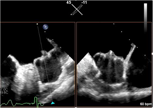 Ischemic stroke associated with high-grade pedunculated device-related thrombosis following left atrial appendage closure