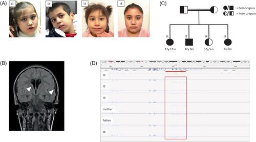 Severe manifestation of Rauch-Azzarello syndrome associated with biallelic deletion of CTNND2