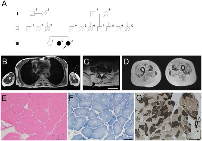 Long-term course of a case with a novel homozygous kyphoscoliosis peptidase variant