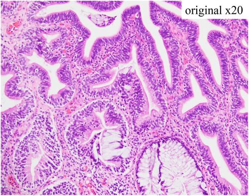 Preoperative oral treatment with cyclooxygenase-2 inhibitor for cystitis glandularis