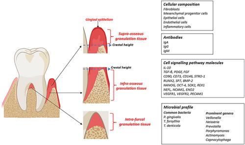 Periodontal granulation tissue – To remove or not to remove, that is the question