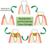 Polymeric biomaterials for periodontal tissue engineering and periodontitis