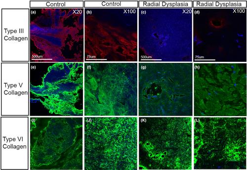 Investigating the role connective tissue fibroblasts play in the altered muscle anatomy associated with the limb abnormality, Radial Dysplasia