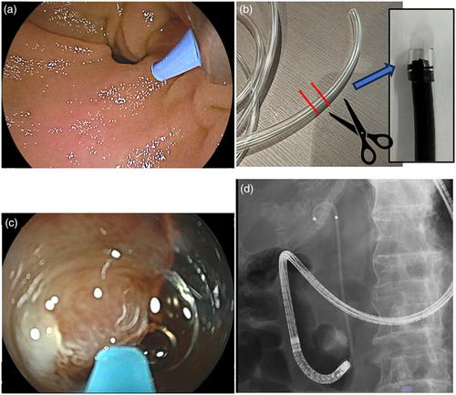 Cap-fitted ultrathin endoscope-assisted endoscopic retrograde cholangiopancreatography (ERCP) for patients with hidden papillae in duodenal diverticula