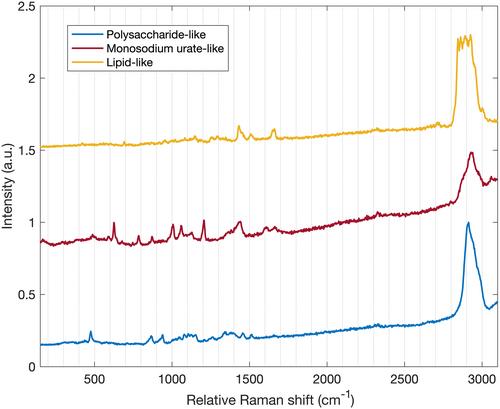 Diagnostic Accuracy of Raman Spectroscopy Integrated With Polarized Light Microscopy for Calcium Pyrophosphate–Associated Arthritis